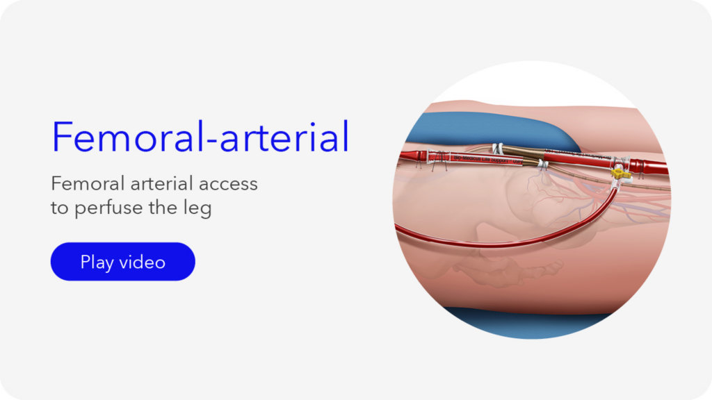 Bio-Medicus Life Support™ Catheter | Medtronic (Europe)