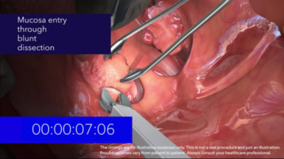 tonsillectomy procedure step by step